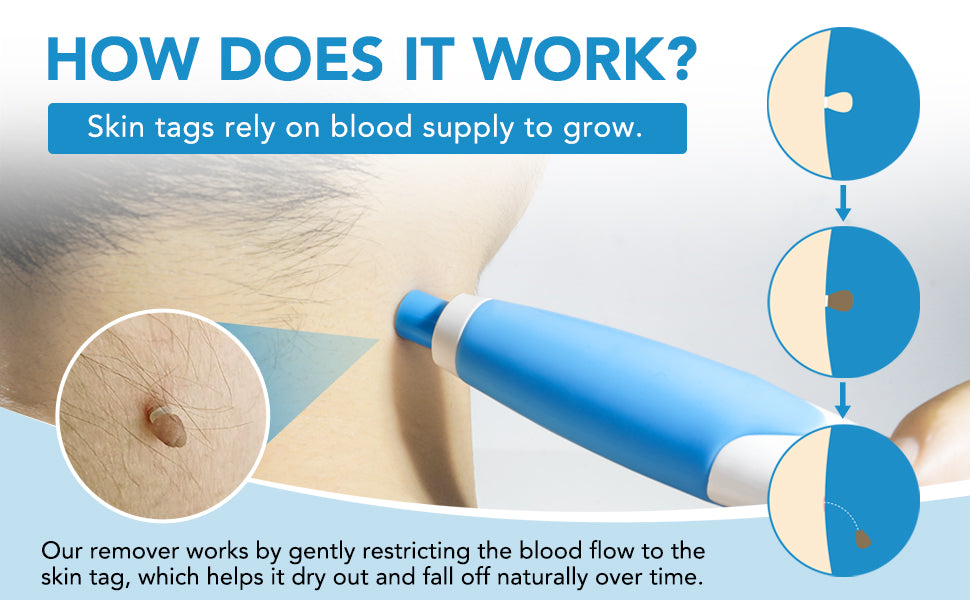 Set zur Entfernung großer & kleiner Stielwarzen mit Tupfern - Skin Tag Remover