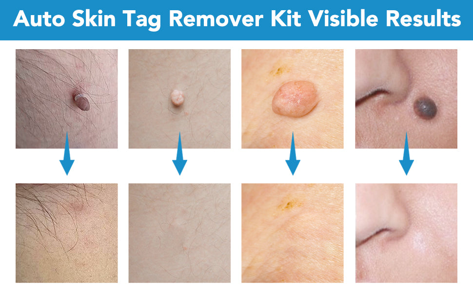 Set zur Entfernung großer & kleiner Stielwarzen mit Tupfern - Skin Tag Remover