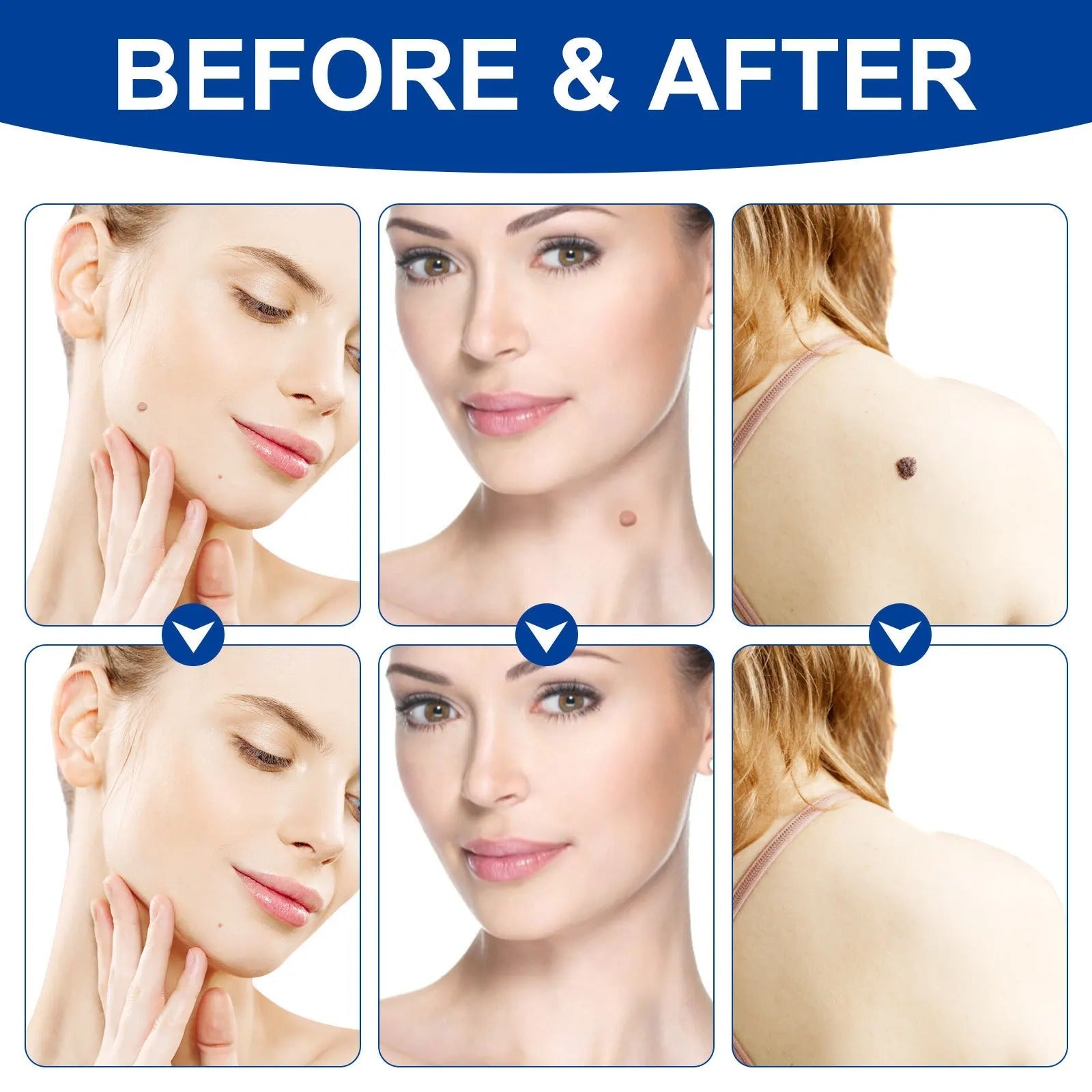 Elektroniktrade Set zur Entfernung großer & kleiner Stielwarzen mit Tupfern - Skin Tag Remover Elektroniktrade Switzerland