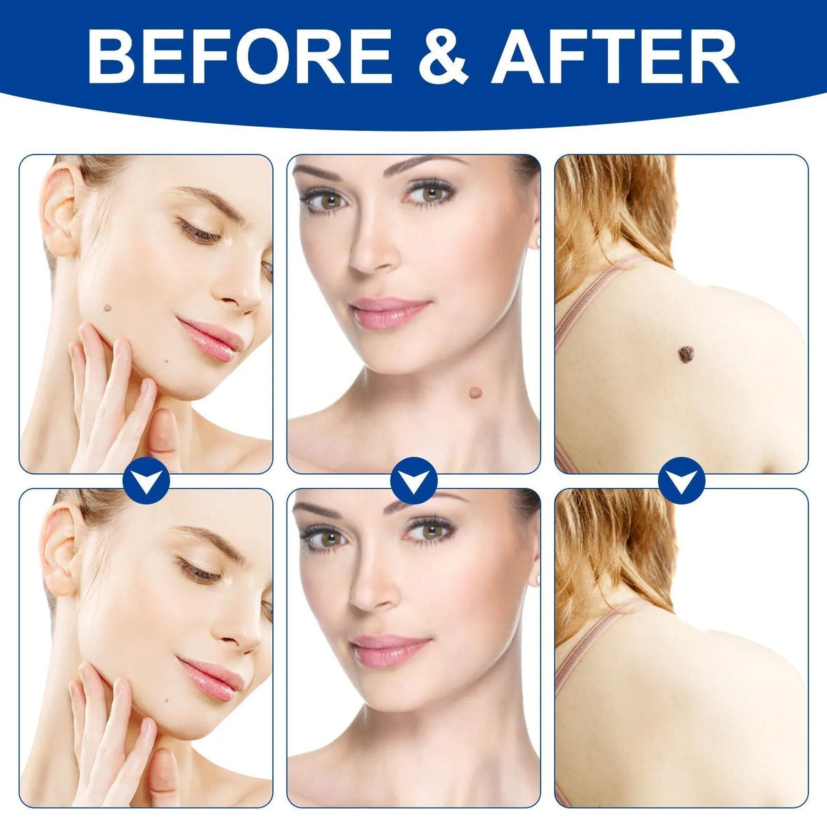 Elektroniktrade Set zur Entfernung großer & kleiner Stielwarzen mit Tupfern - Skin Tag Remover elektroniktrade Switzerland