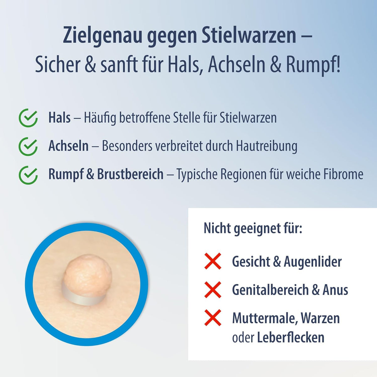 Elektroniktrade Set zur Entfernung großer & kleiner Stielwarzen mit Tupfern - Skin Tag Remover elektroniktrade Switzerland