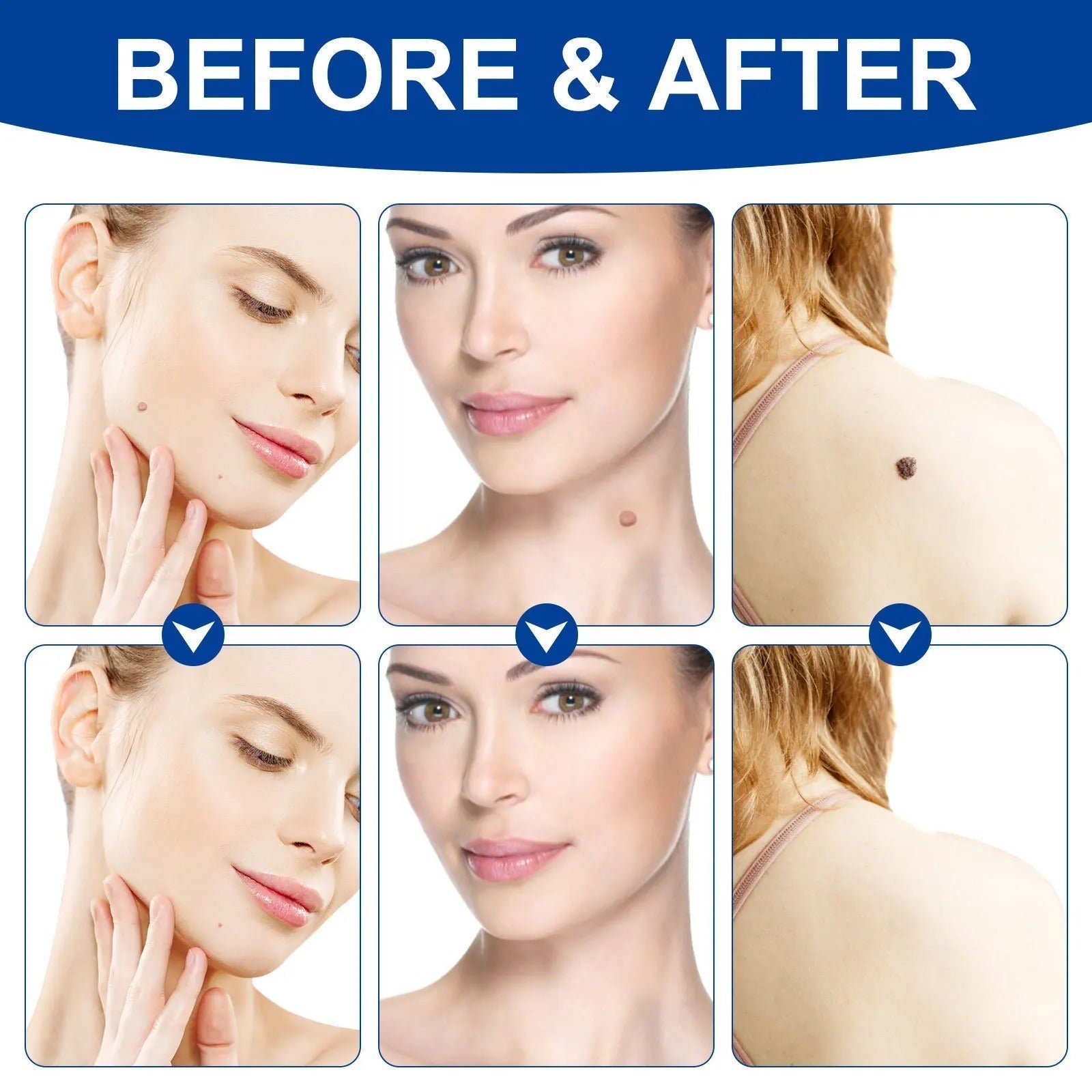 Elektroniktrade Set zur Entfernung großer & kleiner Stielwarzen mit Tupfern - Skin Tag Remover elektroniktrade Switzerland